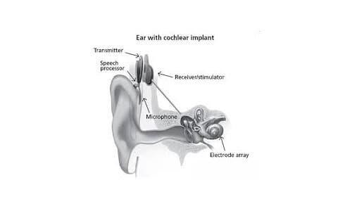 Cochlear Implants